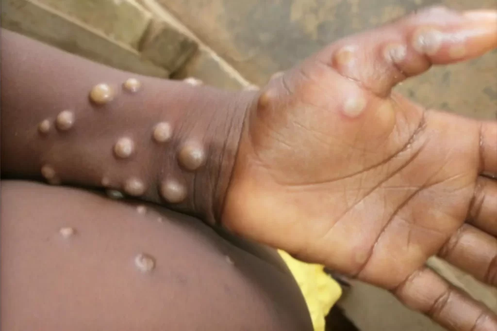 Monkeypox Virus Disease Outbreak Canada