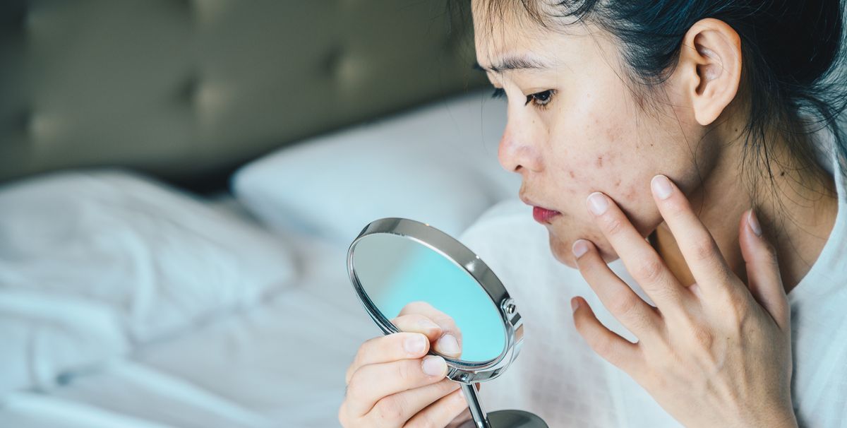 4 Skin Care For Acne Scars For Dark Spot According To Dermatologist