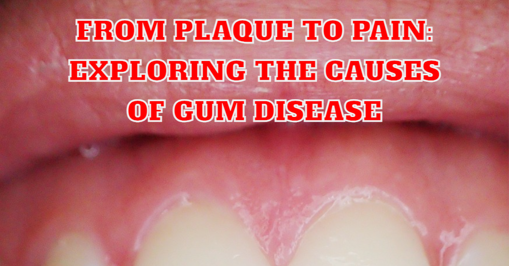 From Plaque to Pain Exploring the Causes of Gum Disease